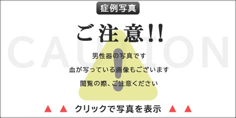 亀頭増大 写真|長茎術・増大術の症例写真を専門医が年齢別（20代〜…